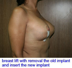 plastic-surgery-breast-lift-augmentation