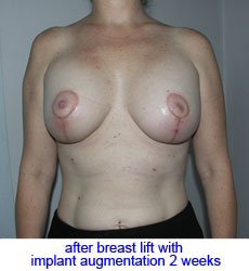 plastic-surgery-breast-lift-augmentation