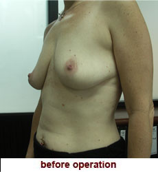plastic-surgery-breast-lift-augmentation