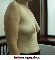 plastic-surgery-breast-lift-augmentation