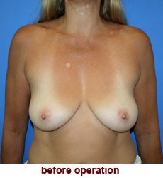 plastic-surgery-breast-lift-augmentation