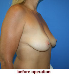 plastic-surgery-breast-lift-augmentation