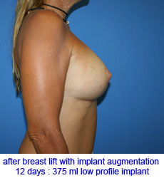 plastic-surgery-breast-lift-augmentation
