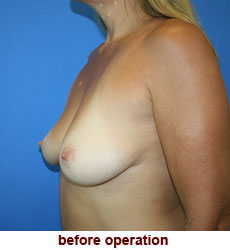 plastic-surgery-breast-lift-augmentation