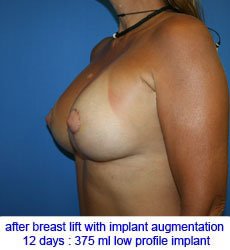 plastic-surgery-breast-lift-augmentation