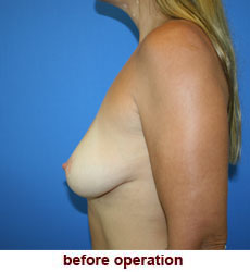 plastic-surgery-breast-lift-augmentation