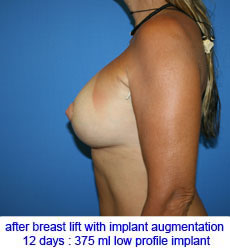 plastic-surgery-breast-lift-augmentation