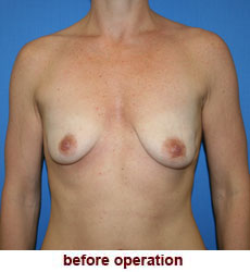 plastic-surgery-breast-lift-augmentation