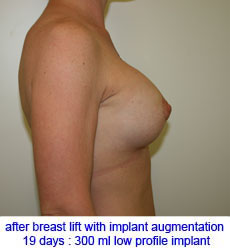 plastic-surgery-breast-lift-augmentation