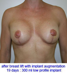 plastic-surgery-breast-lift-augmentation