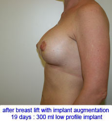 plastic-surgery-breast-lift-augmentation