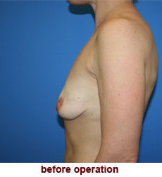 plastic-surgery-breast-lift-augmentation