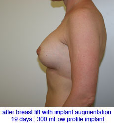 plastic-surgery-breast-lift-augmentation