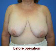 plastic-surgery-breast-reduction
