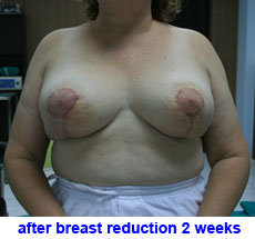 plastic-surgery-breast-reduction