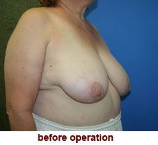 plastic-surgery-breast-reduction