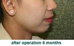 plastic-surgery-chin-augmentation
