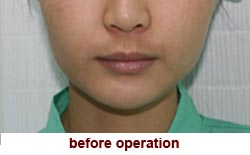 plastic-surgery-chin-augmentation