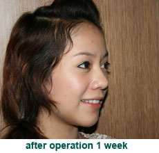 plastic-surgery-chin-augmentation