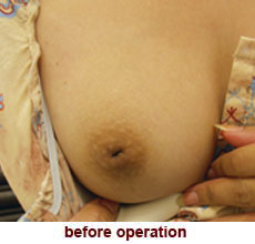 plastic_surgery_inverted_nipple_correction