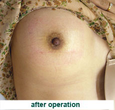 plastic_surgery_inverted_nipple_correction