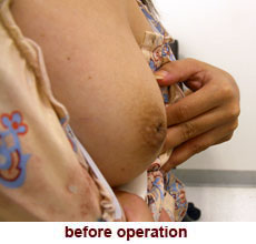 plastic_surgery_inverted_nipple_correction