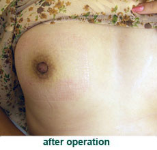 plastic_surgery_inverted_nipple_correction