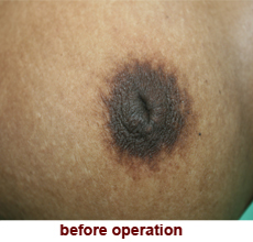 plastic_surgery_inverted_nipple_correction