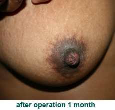 plastic_surgery_inverted_nipple_correction