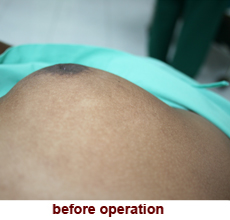 plastic_surgery_inverted_nipple_correction