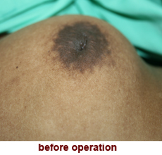plastic_surgery_inverted_nipple_correction