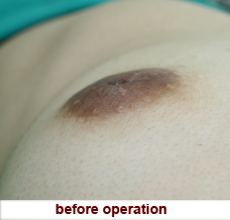 plastic_surgery_inverted_nipple_correction