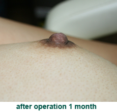 plastic_surgery_inverted_nipple_correction