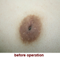 plastic_surgery_inverted_nipple_correction