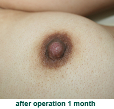 plastic_surgery_inverted_nipple_correction