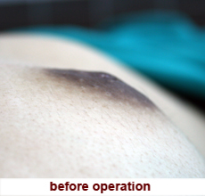 plastic_surgery_inverted_nipple_correction