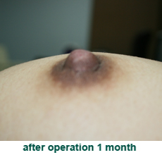 plastic_surgery_inverted_nipple_correction