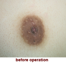 plastic_surgery_inverted_nipple_correction