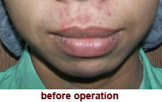 plastic-surgery-lip-reduction