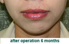 plastic-surgery-lip-reduction