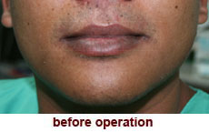 plastic-surgery-lip-reduction
