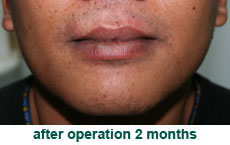 plastic-surgery-lip-reduction