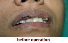 plastic-surgery-lip-revision