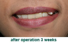 plastic-surgery-lip-revision