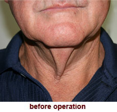 plastic-surgery-neck-lift