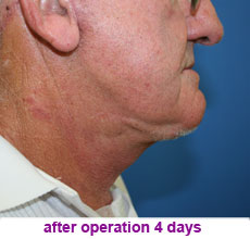 plastic-surgery-neck-lift