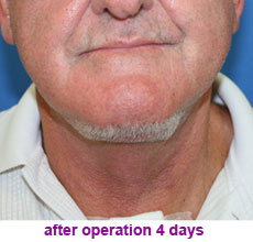 plastic-surgery-neck-lift