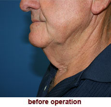 plastic-surgery-neck-lift