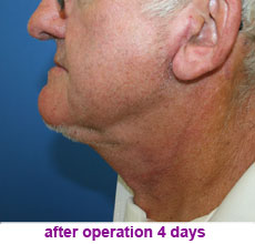 plastic-surgery-neck-lift