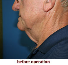plastic-surgery-neck-lift